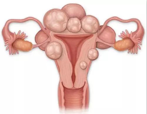 后壁肌壁间子宫肌瘤影响怀孕吗,子宫肌瘤腹腔镜手术后影响怀孕吗
