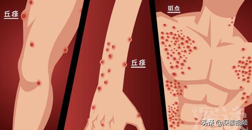 梅毒上热搜，隐私部位出现啥样要警惕？