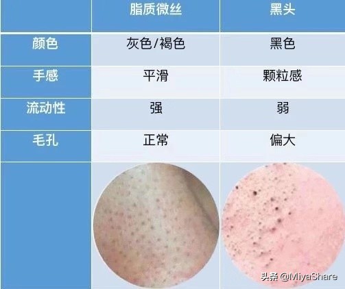 不靠谱的去黑头方法你试过哪几种,真假黑头教你如何正确去黑头