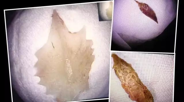 吃东西卡住怎么办,吃东西卡住怎么弄