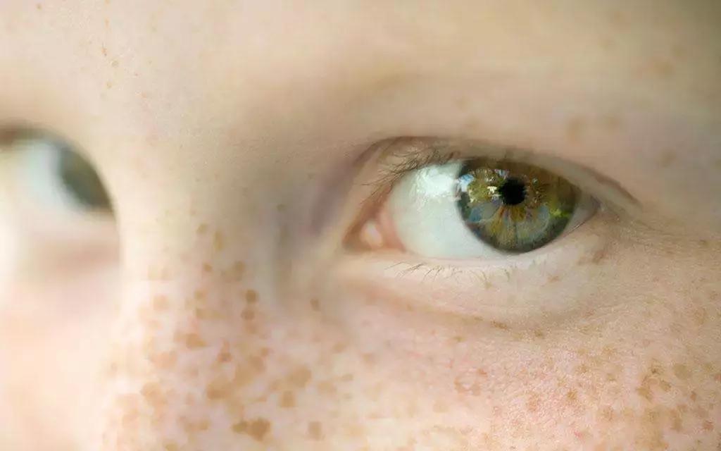 长出的斑怎么消除,长色斑怎么办5大方法祛除色斑