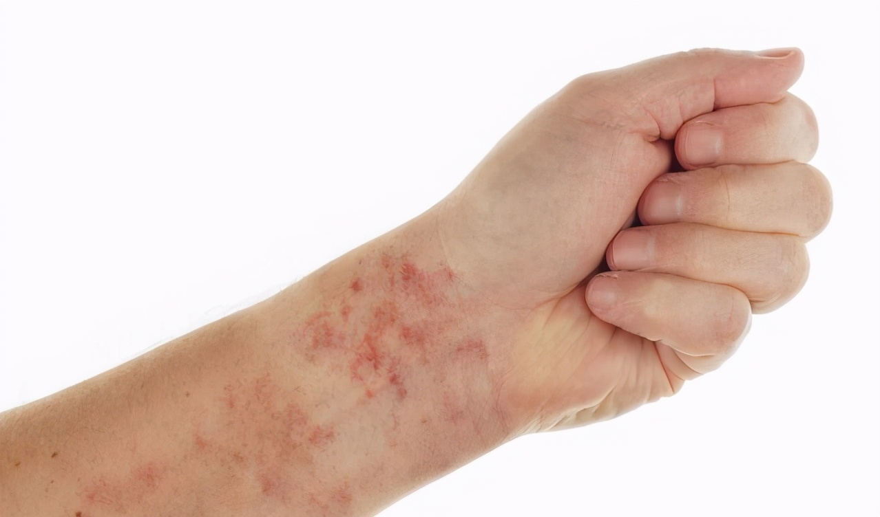 过敏性紫癜是多大的年龄发病,过敏性紫癜得病的原因和危害性