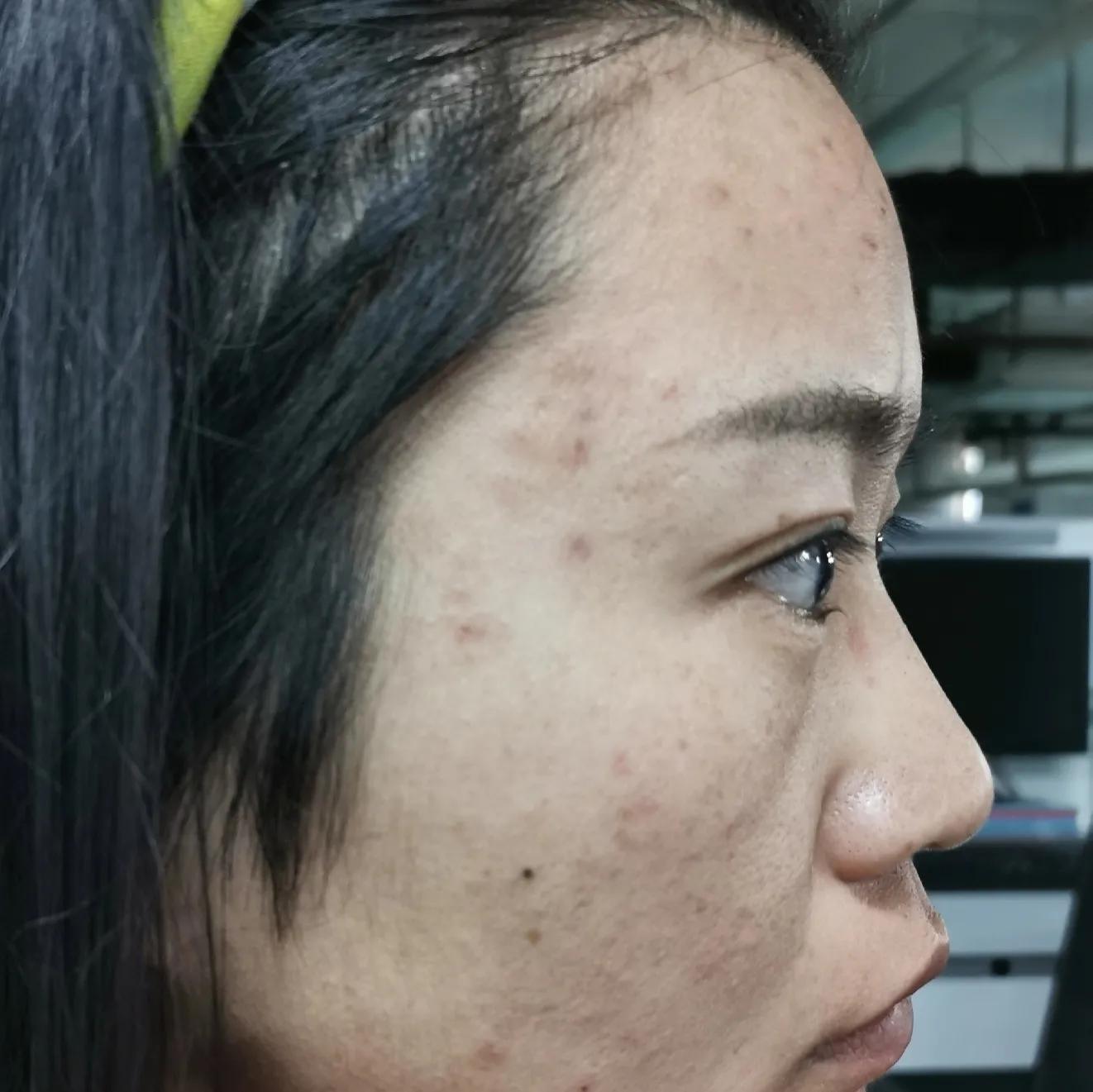 吐血总结祛痘膏,反反复复爆痘怎么都不管用