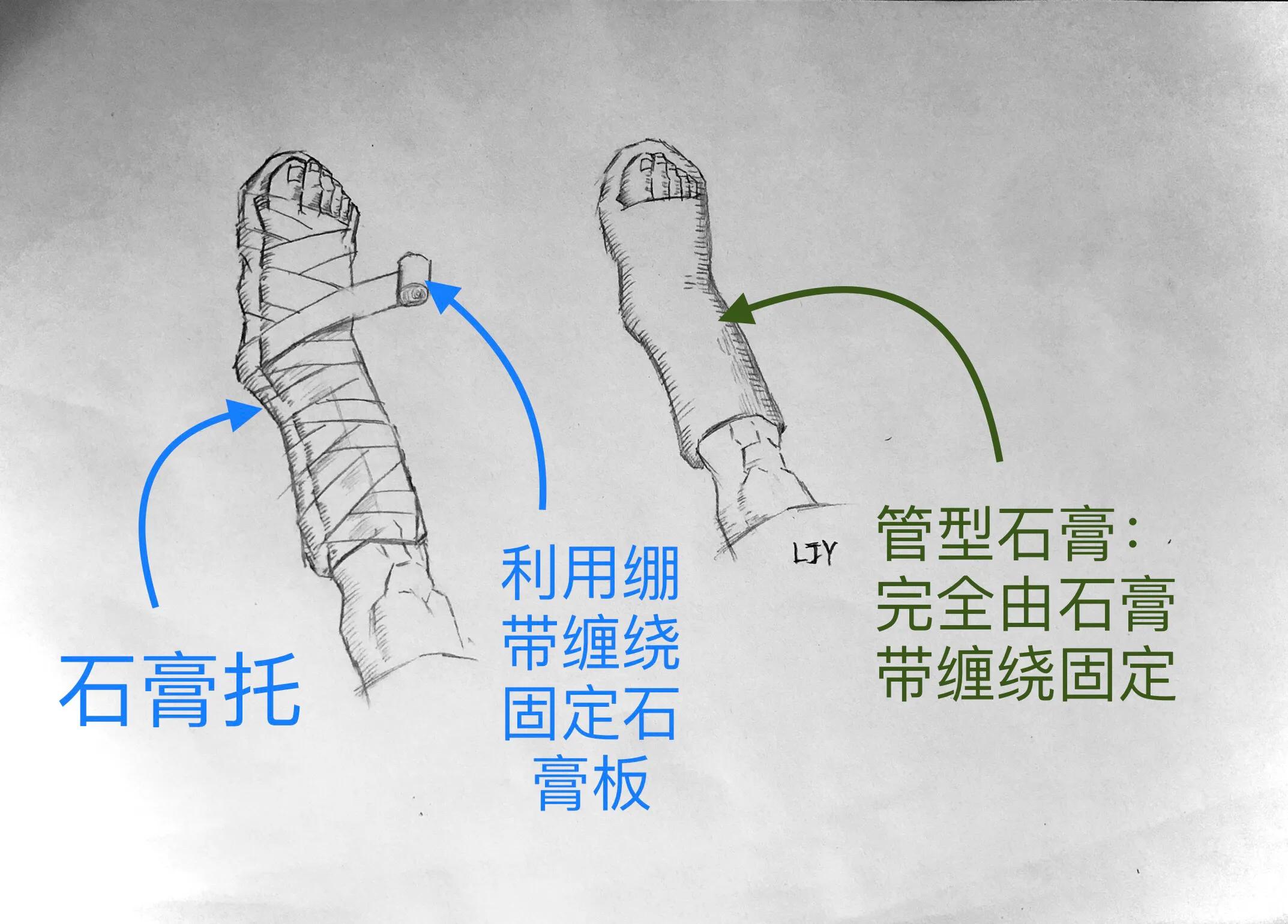 踝关节扭伤后有何表现,踝关节扭伤的自我判断与治疗