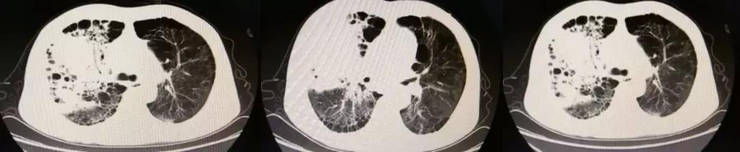 抗菌药物不合理处方分析,抗菌药物用药不合理的表现