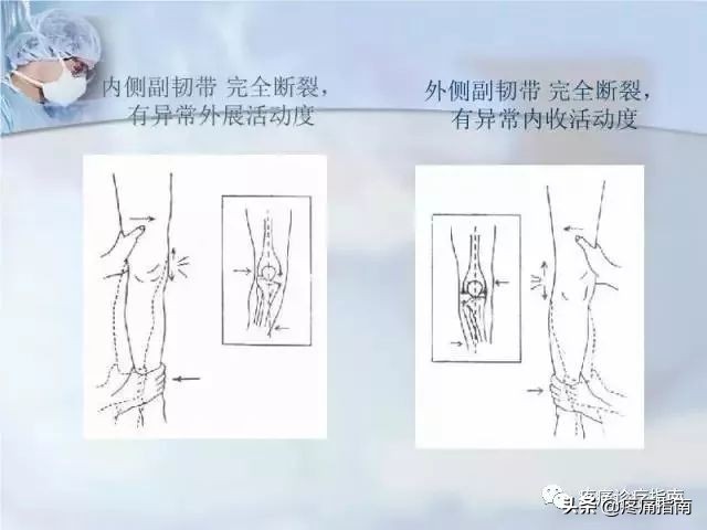 左膝关节内侧副韧带1度损伤,膝关节外侧副韧带撕裂的症状