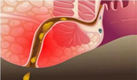 治疗肛瘘该去哪家医院,北京广安门中医院肛肠科肛瘘