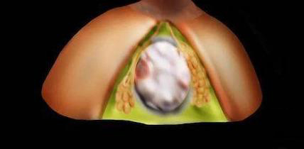 一年之内长了一个乳腺纤维瘤,胸里长纤维瘤用做手术吗