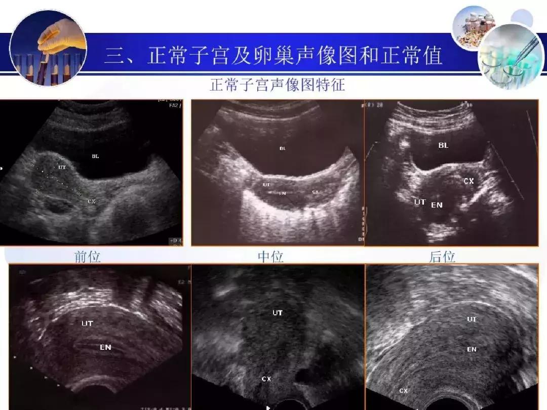纯干货！子宫及附件解剖和超声诊断