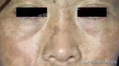 褐青色雀斑多久能治好,脸上起褐斑怎么治效果快