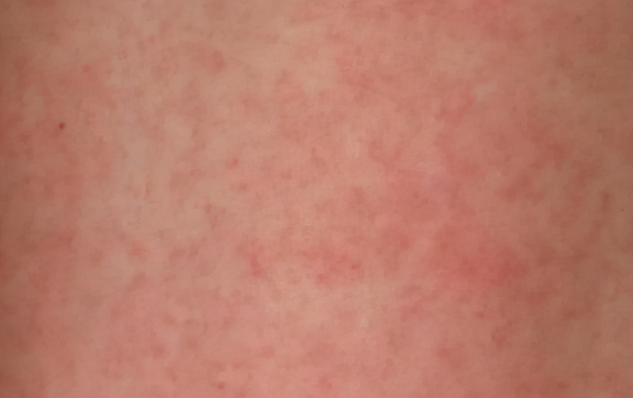 错把艾滋病当皮肤病,别错把艾滋当成皮肤病