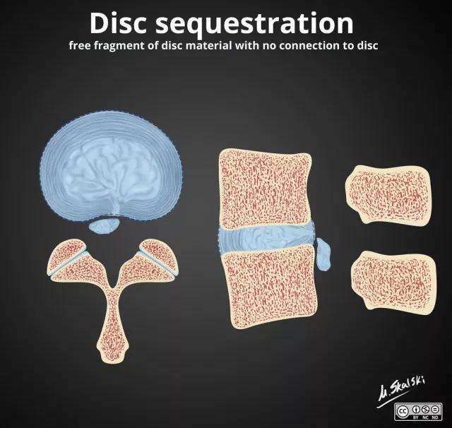 椎间盘膨出影像学表现,椎间盘脱出和突出鉴别影像学表现
