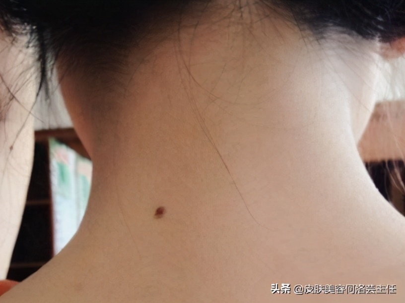 皮肤刷酸后要敷什么面膜好,皮肤刺痛的原因