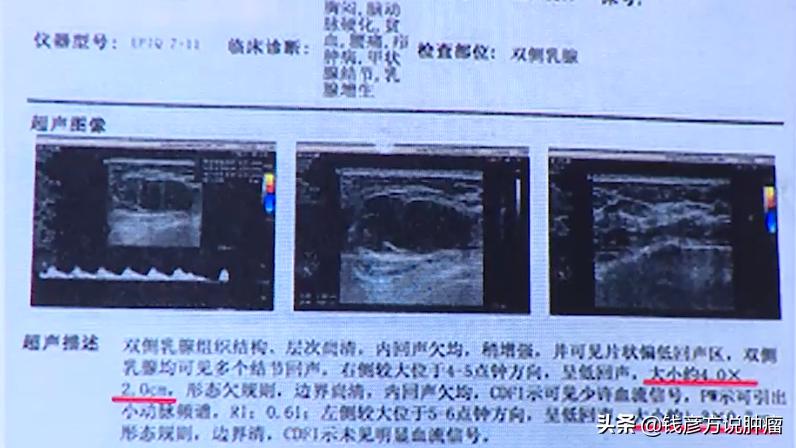 子宫肌瘤结节怎么治疗效果好,45周岁子宫肌瘤乳腺结节三级