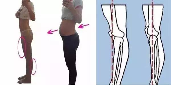 膝关节超伸原因以及调理方法