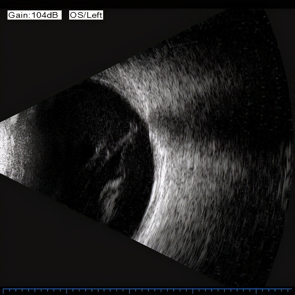 每分钟20000转,陈旧视网膜脱离治疗奇迹