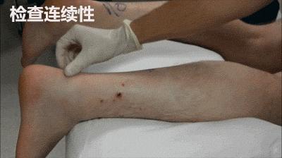 小腿感觉被人踢了跟腱断裂,踢一脚跟腱断裂