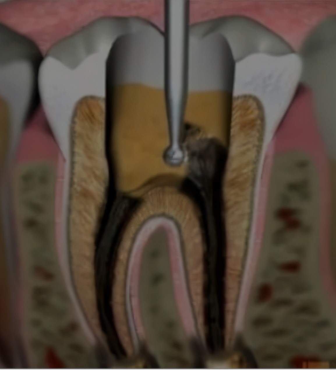 根管治疗封药后为什么反反复复疼痛?
