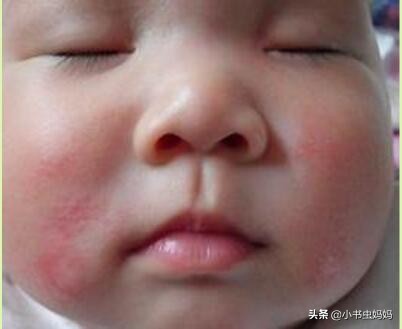 三个月宝宝喝奶粉为什么反复奶癣,一岁宝宝奶癣怎么根治