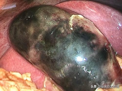 胆囊炎相当于中医的哪个病,胆囊炎的诱因及病理过程