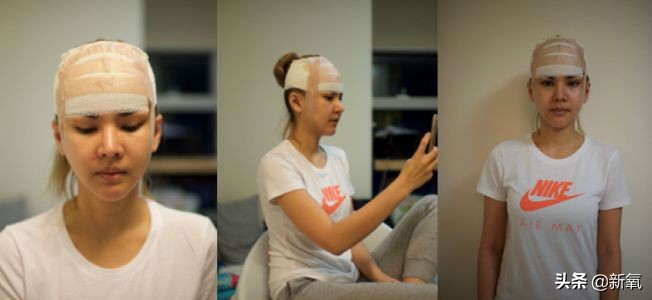 18岁土肥圆豪掷800万全身整形，鼻子6次大整假体穿出，效果却超美