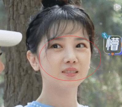 哪个明星做了颧骨内推,颧骨内推明星前后对比