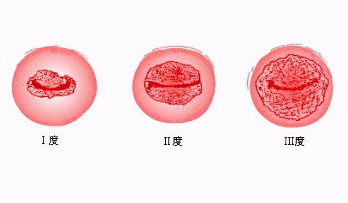 hpv感染合并宫颈息肉,hpv感染合并慢性宫颈炎
