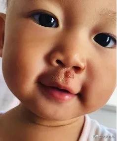 宝宝擦伤的正确处理方法,宝宝擦伤了该怎么办