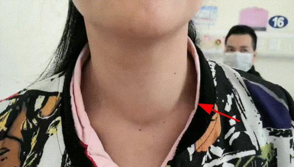 甲状腺结节微创消融手术,甲状腺结节微创消融医保