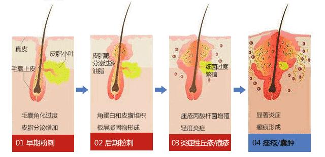 治疗痘痘到哪个医院好啊,怎么治疗痘痘最经典有效