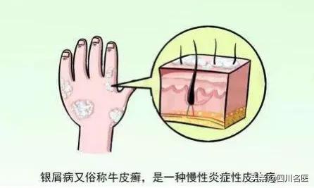 钱没少花却过得一塌糊涂,得了银屑病怎么开导