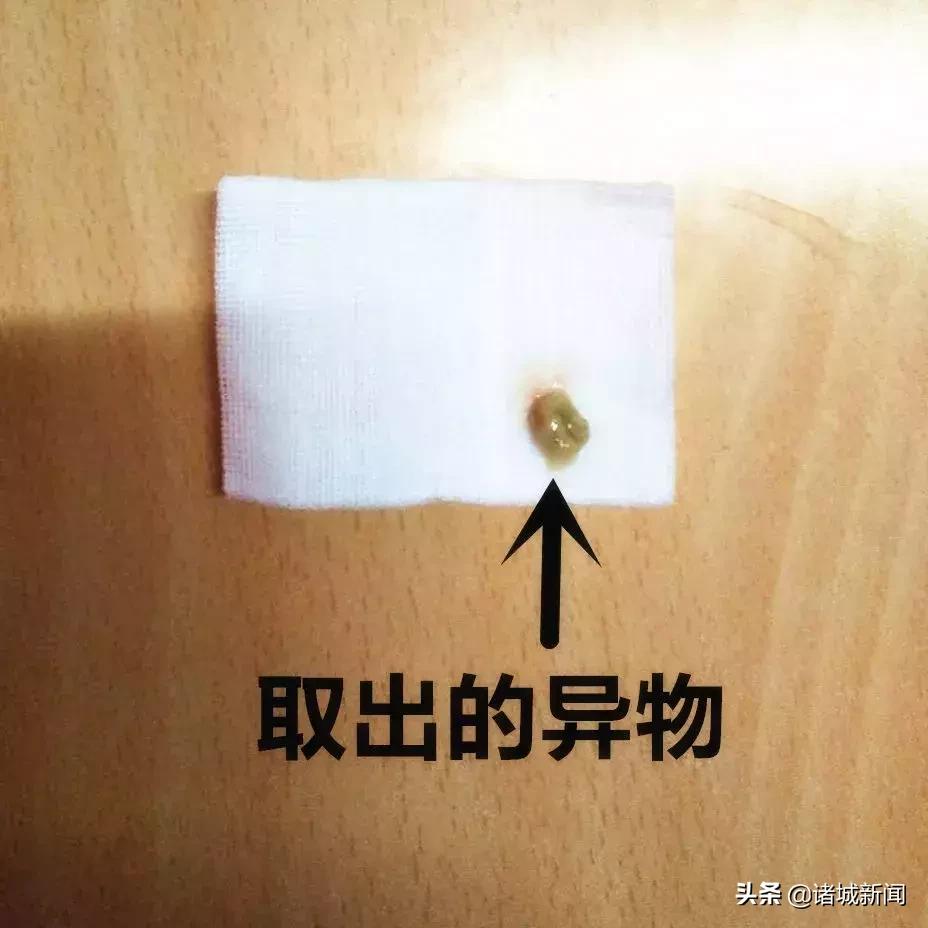 一岁半孩子流黄鼻涕20多天好不了,7岁孩子老是流黄鼻涕一个月了