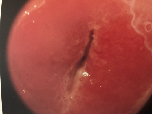 宫颈肥大跟宫颈糜烂是同一种病吗,宫颈糜烂不是病为何还在治