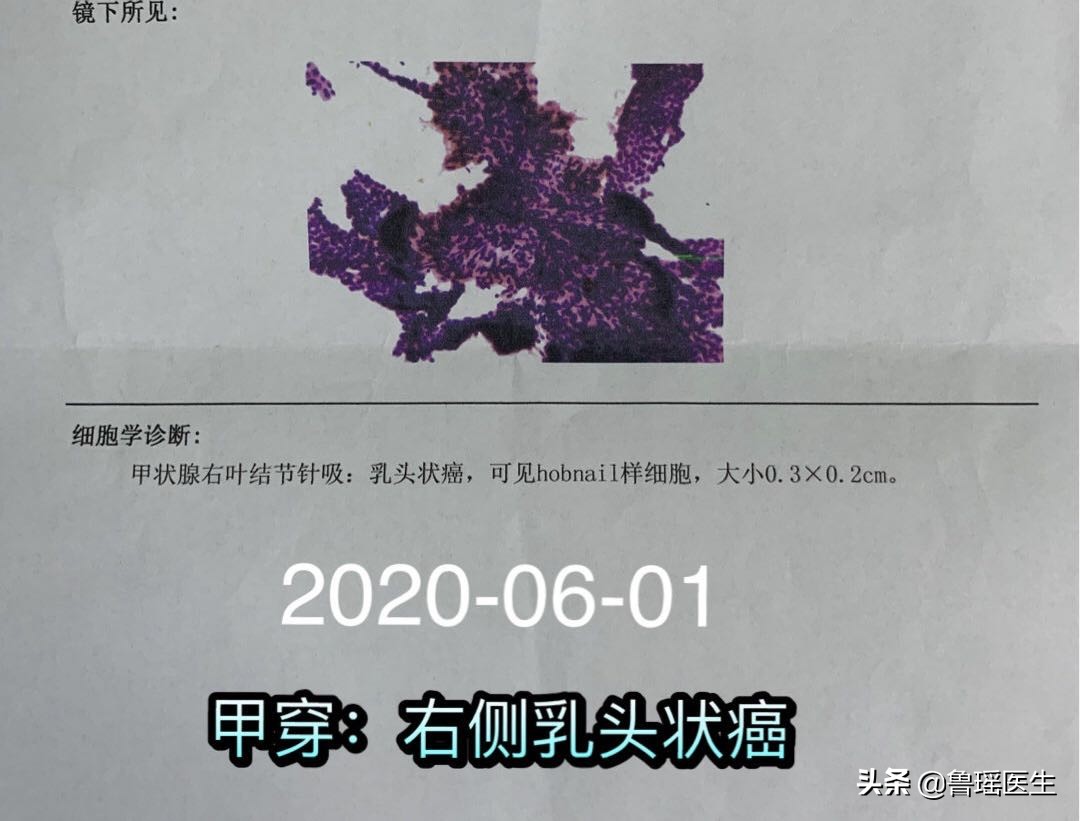 甲状腺结节超声提示恶性五大征象,甲状腺结节b超误诊