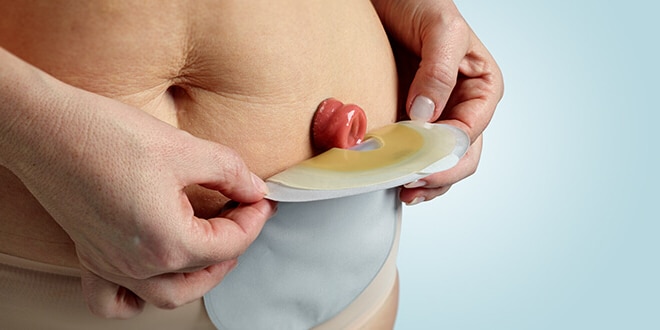 肠癌晚期腹腔转移肠梗阻如何造口,肠癌引起肠梗阻能治愈吗