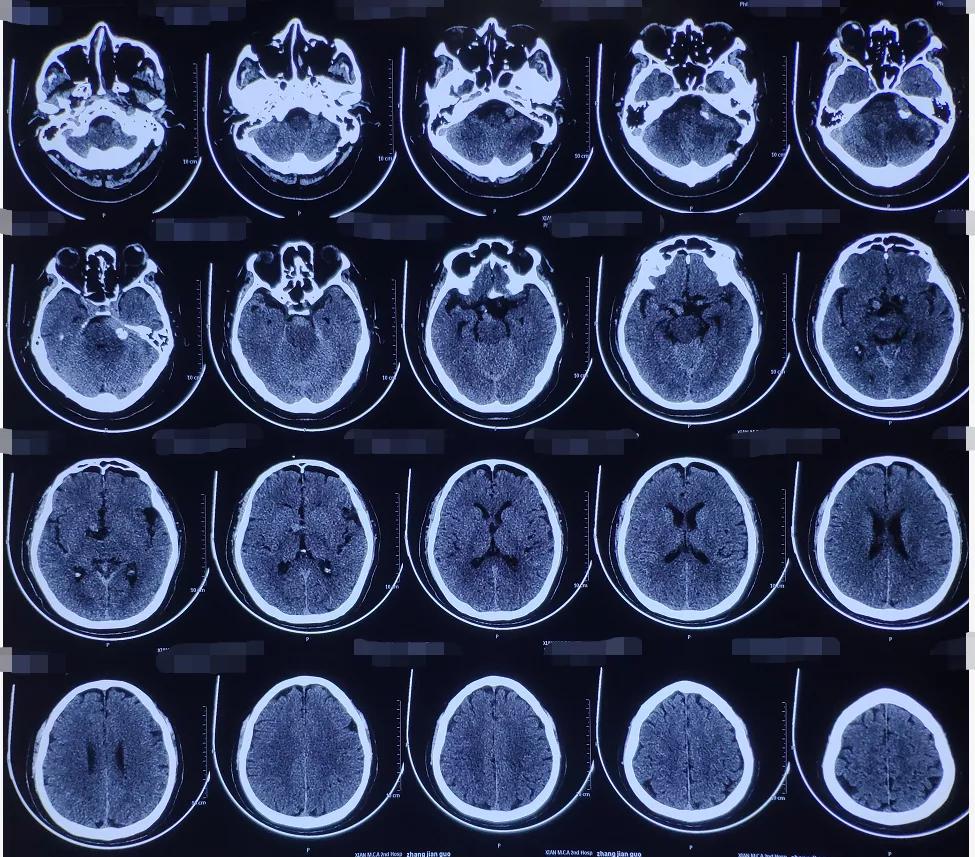 面肌痉挛球囊压迫和微血管减压术,微血管减压术治疗三叉神经痛