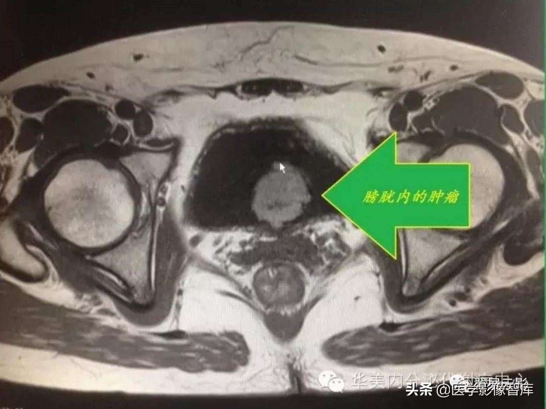 18种泌尿生殖系统常见疾病MR诊断总结