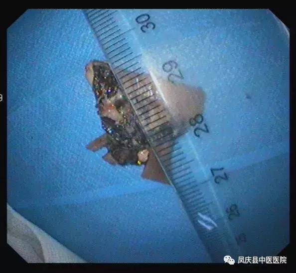 凤庆中医：谨慎“吃鸡”，食管异物取出化危急