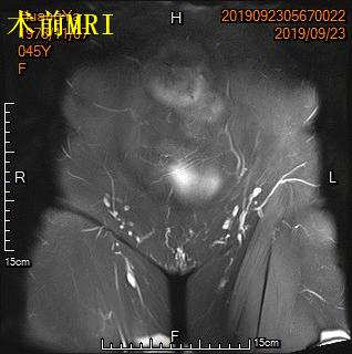 子宫肌瘤什么情况适合用介入栓塞,子宫肌瘤能做栓塞介入吗