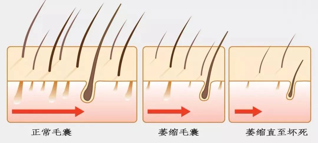 m型脱发1-7级程度图片,m型脱发后长出绒毛能恢复吗