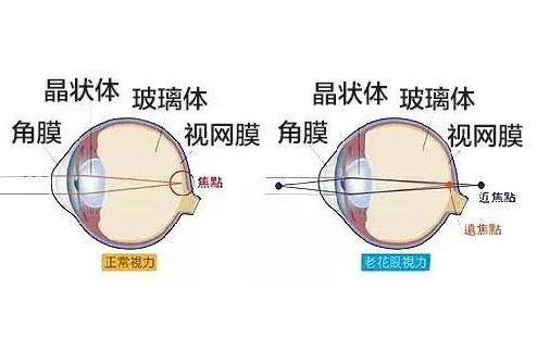 远视和老花的区别,怎么区别老花还是远视