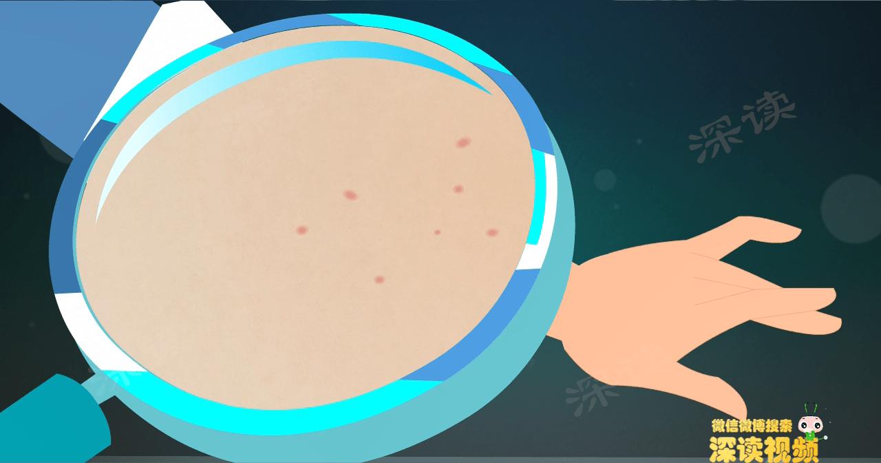 尖锐性湿疣会引起hpv感染吗,HPV感染几率有多高