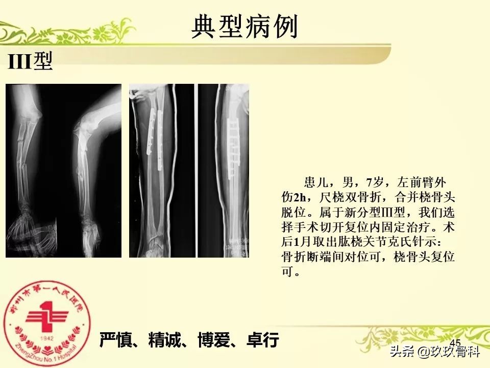 孟氏骨折功能训练多久能恢复正常,孟氏骨折中医能治吗