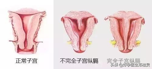 备孕科普:纵膈子宫有什么危害?能顺利怀孕生子吗?
