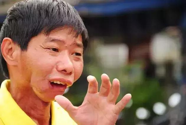 因为吃槟榔而被割掉牙床,嚼槟榔被割掉嘴巴的有多少人了