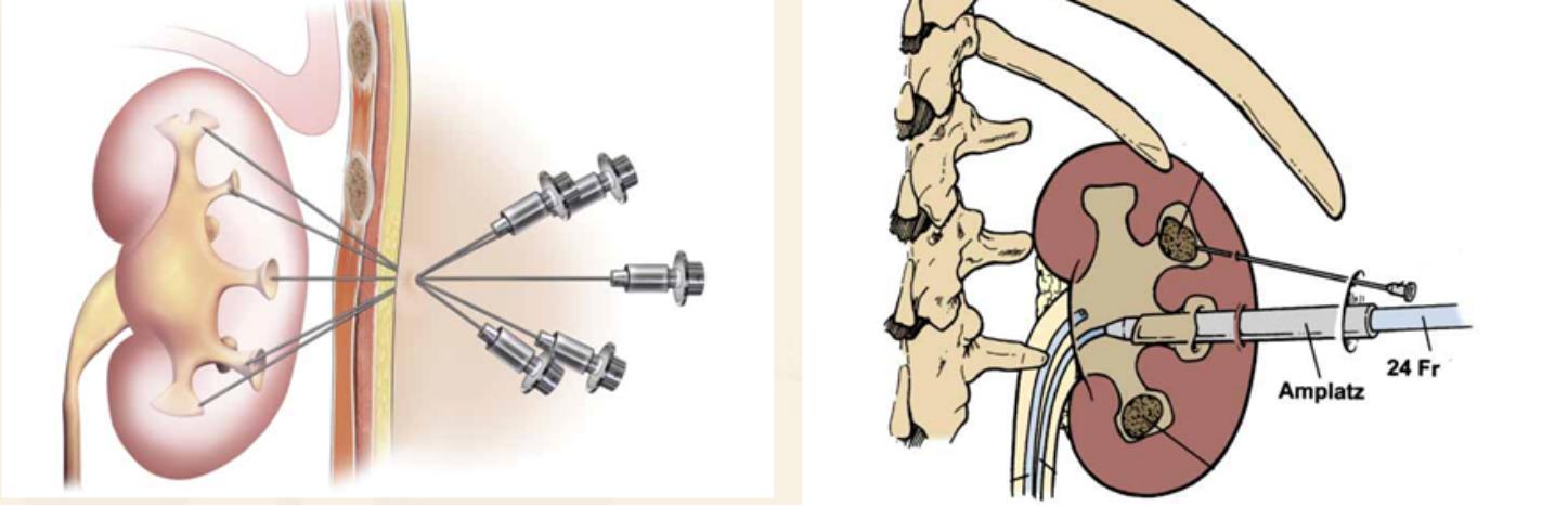 疯狂的石头除藻,肾结石鹿角形状的结石什么样