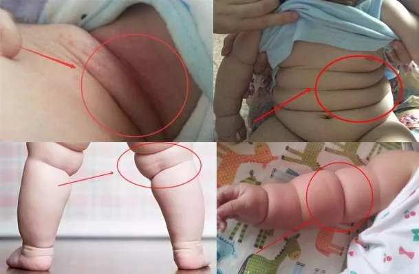 痱子止痒,有效的祛痱子方法