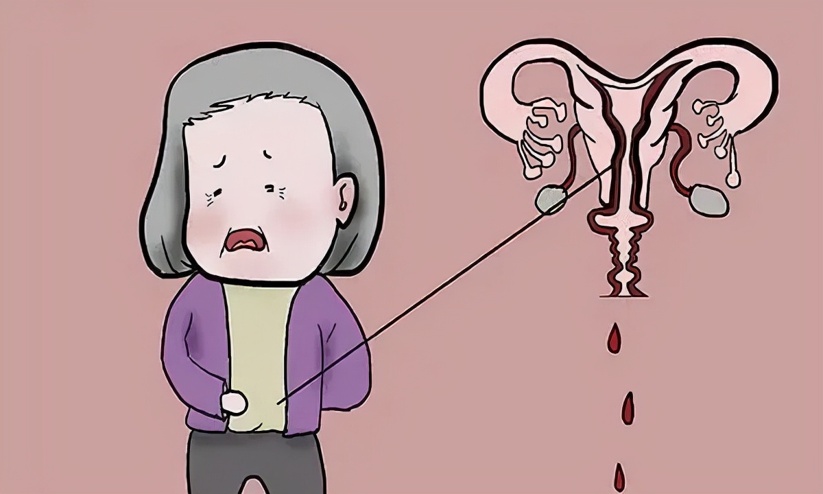 上环真有那么可怕吗,上环的误区