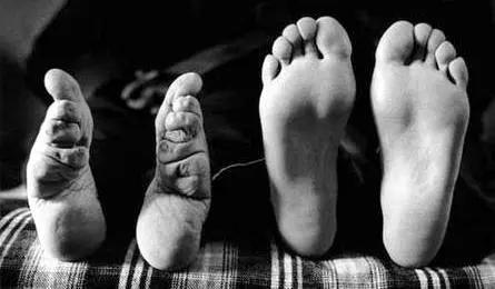 漏尿与内脏下垂,漏尿盆骨下垂