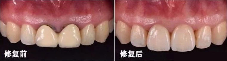 假牙以旧换新,口腔假牙以旧换新活动